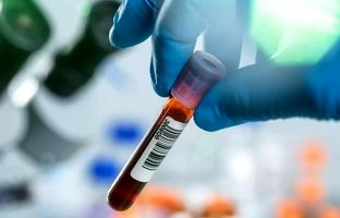  شناسایی سرطان 3 سال قبل از بروز با این آزمایش خون!