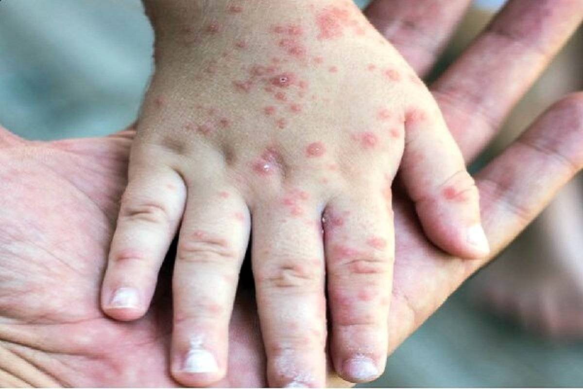 چه کسانی برای اربعین باید واکسن سرخک بزنند؟