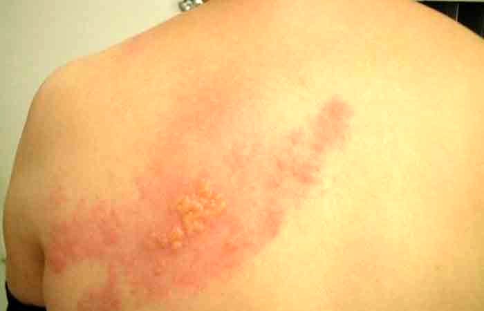 (ویدئو) درد بعد از ابتلا به زونا را چگونه کم کنیم؟