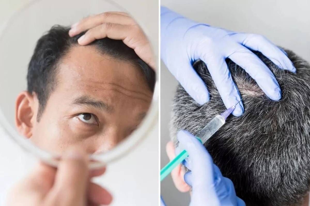 روشی برای فرار از طاسی؛ «بوتاکس جدید» با ریزش مو مقابله میکند