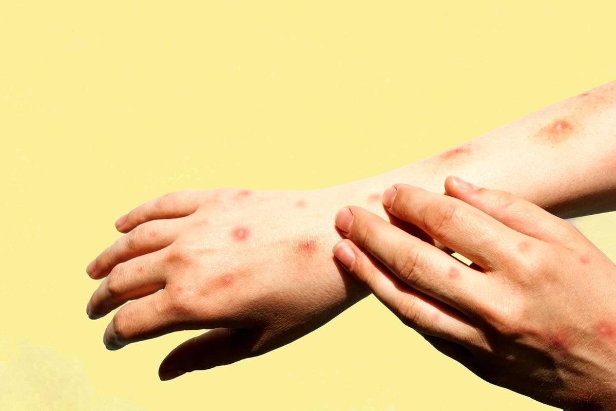 مینو محرز: یک سالونیم پیش بیمار مبتلا به آبله میمونی داشتم