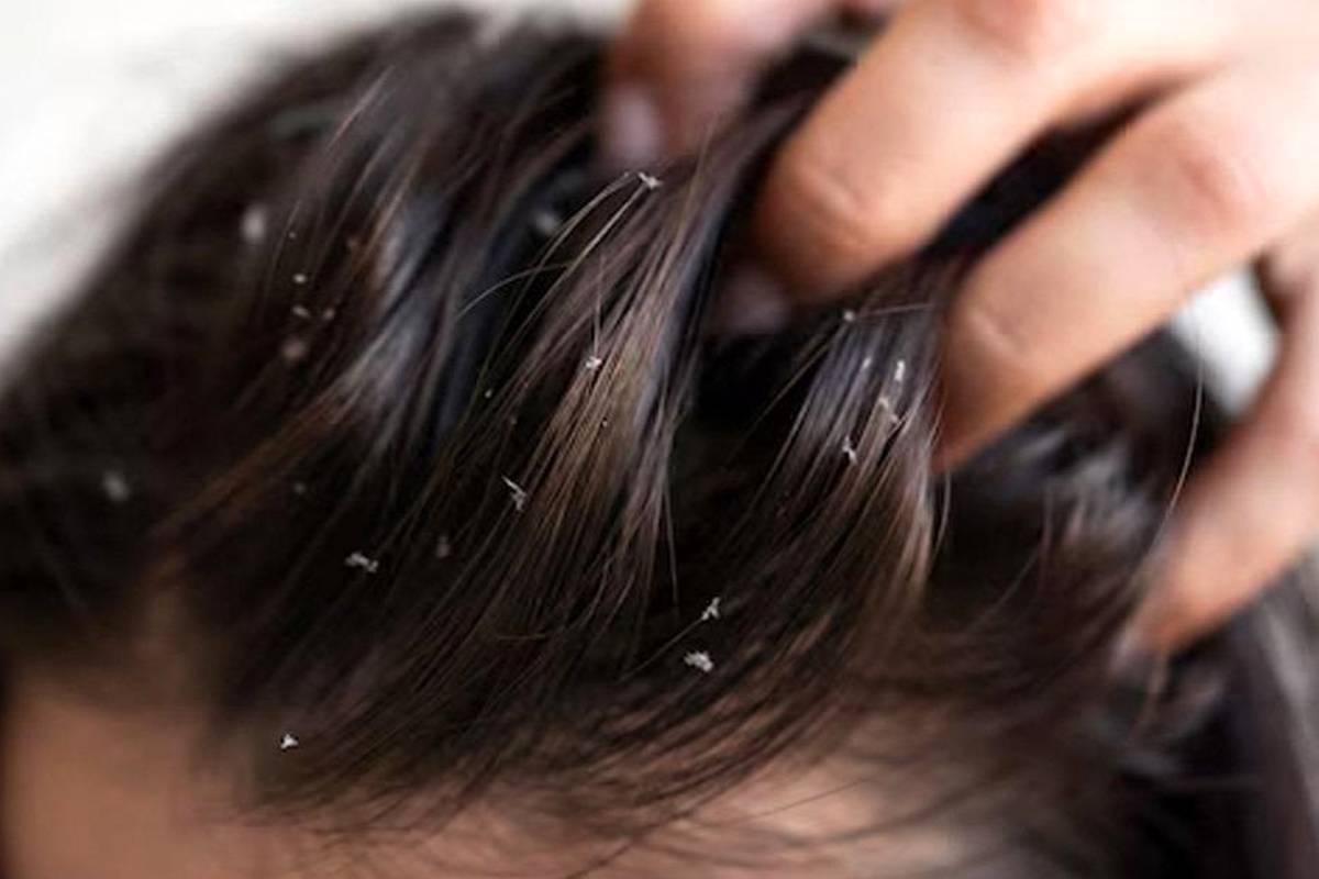 فقط بعد از یک روز، موهایتان چرب می شود؟ علت‌های اصلی که احتمالا نادیده می‌گیرید 