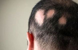 ریزش سکه‌ ای مو را متوقف کنید: راهکار های موثر و علمی + ویدئو