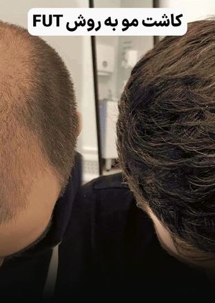کاشت مو چند روش دارد؟ راهنمای انتخاب بهترین روش برای شما