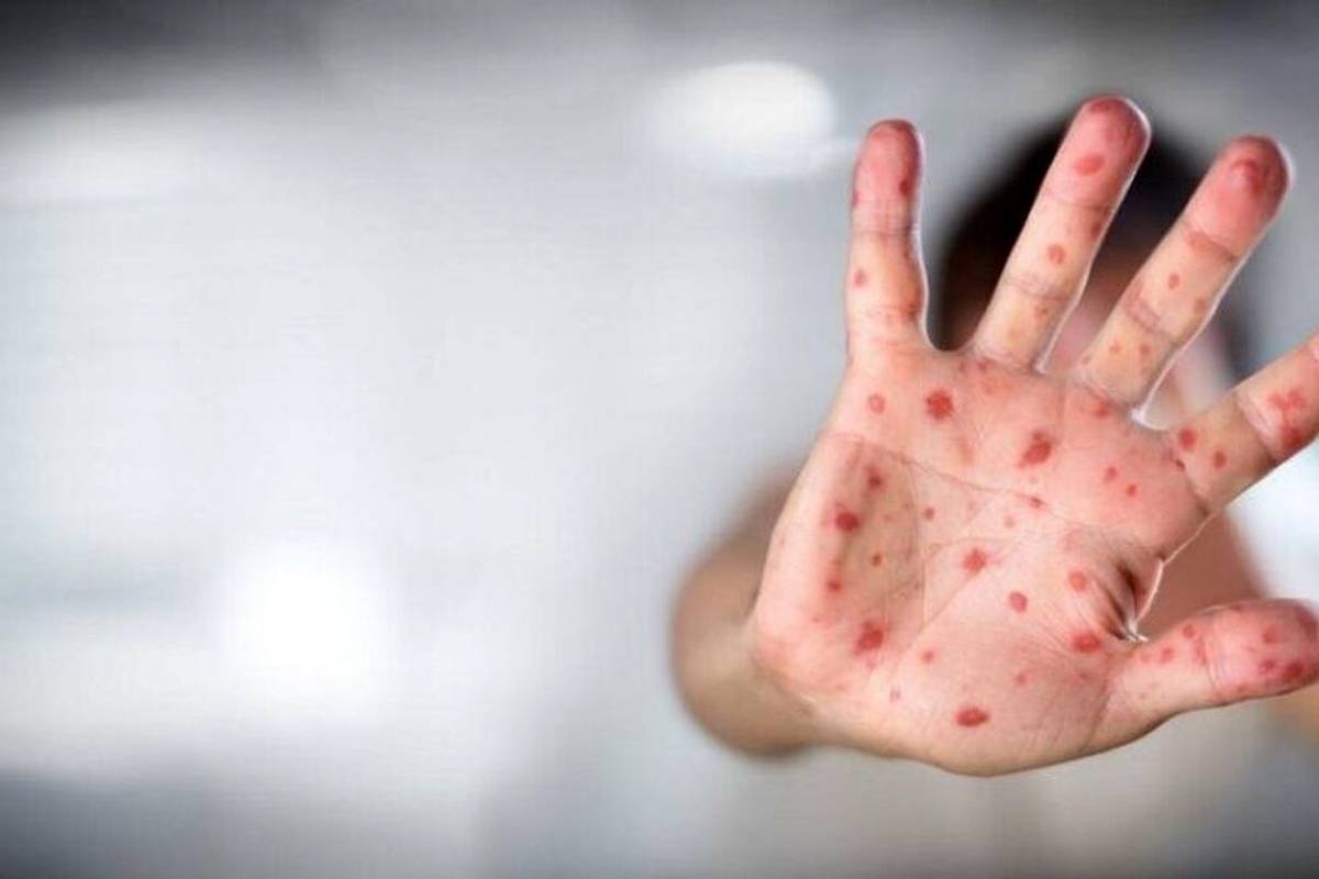 آخرین وضعیت آبله میمونی در کشور؛ اضطرار جهانی «امپاکس»
