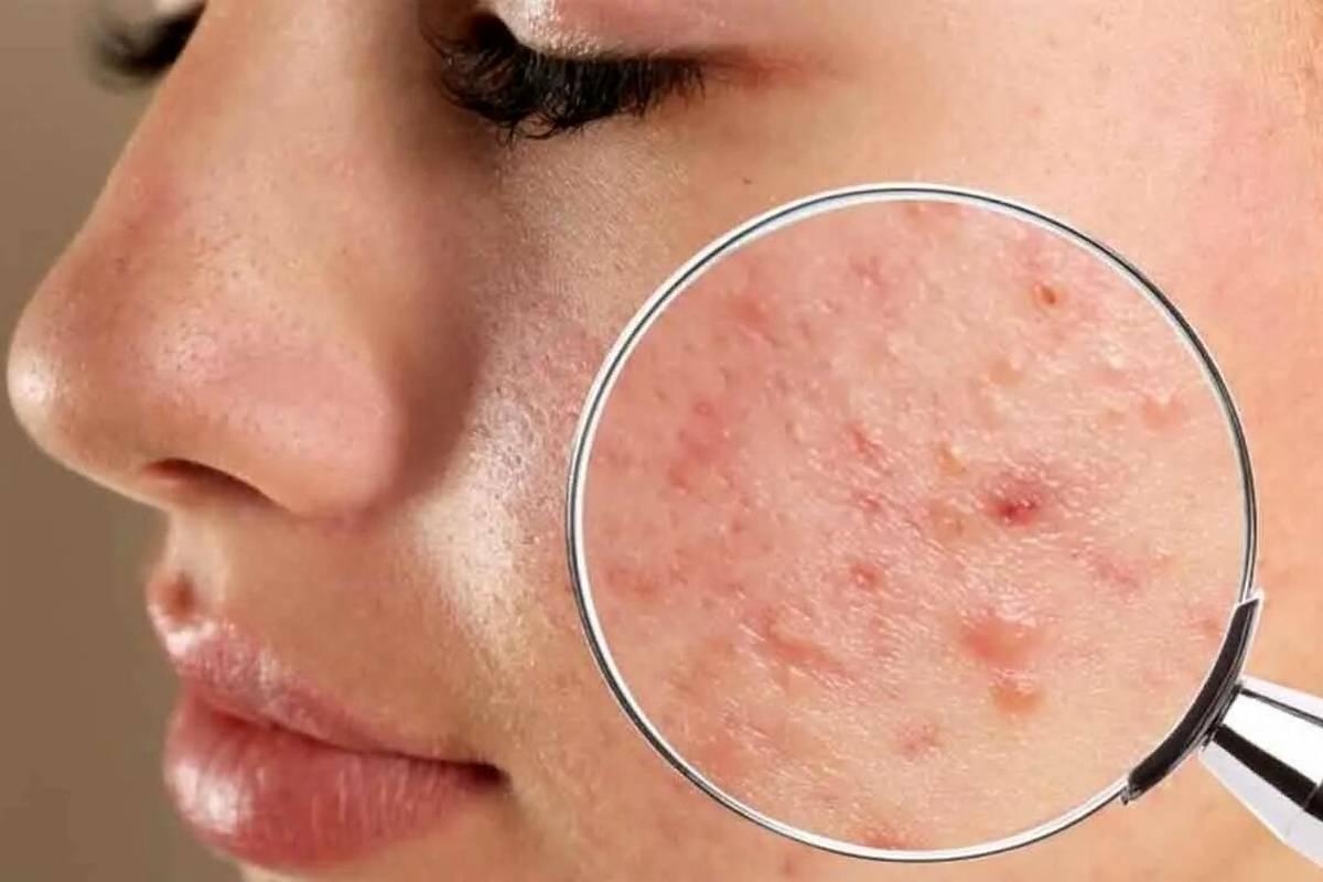 علت اصلی جوش چرکی چیست ؟ ؛ درمان خانگی جوش های چرکی و دردناک