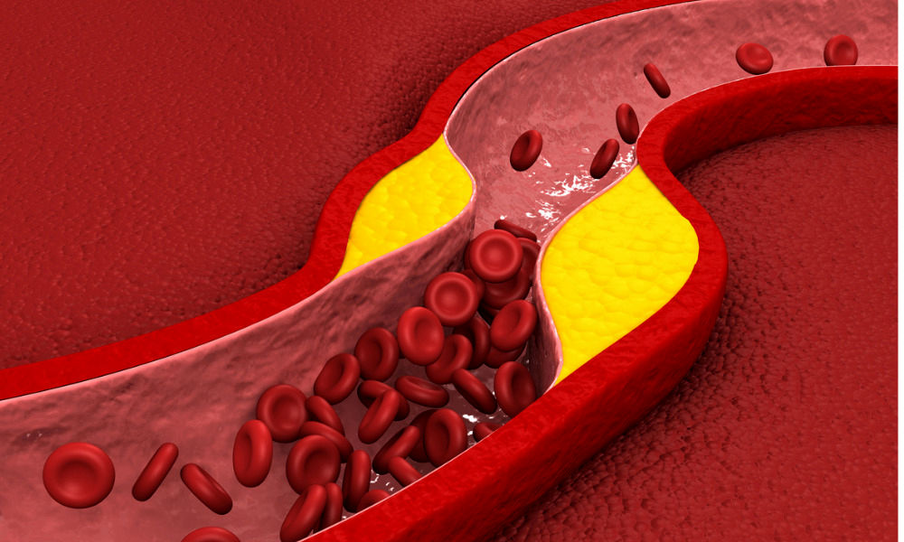 از سیر تا پیاز چربی خون بالا؛ علل، علائم، پیشگیری و انواع درمان