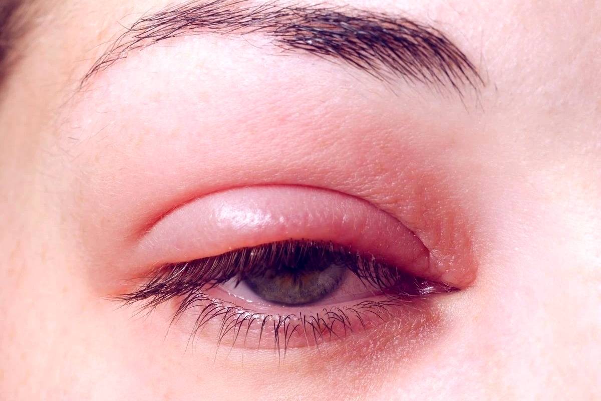 گل مژه چیست و آیا خطرناک است؟ علل، نشانهها و راههای درمان آن