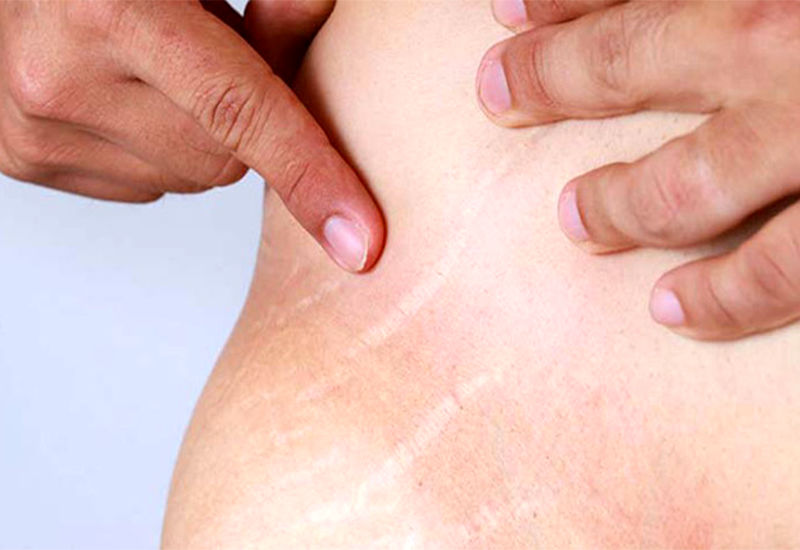 ترک پوستی چیست؟ دلایل ایجاد و راه‌های درمان آن کدامند؟