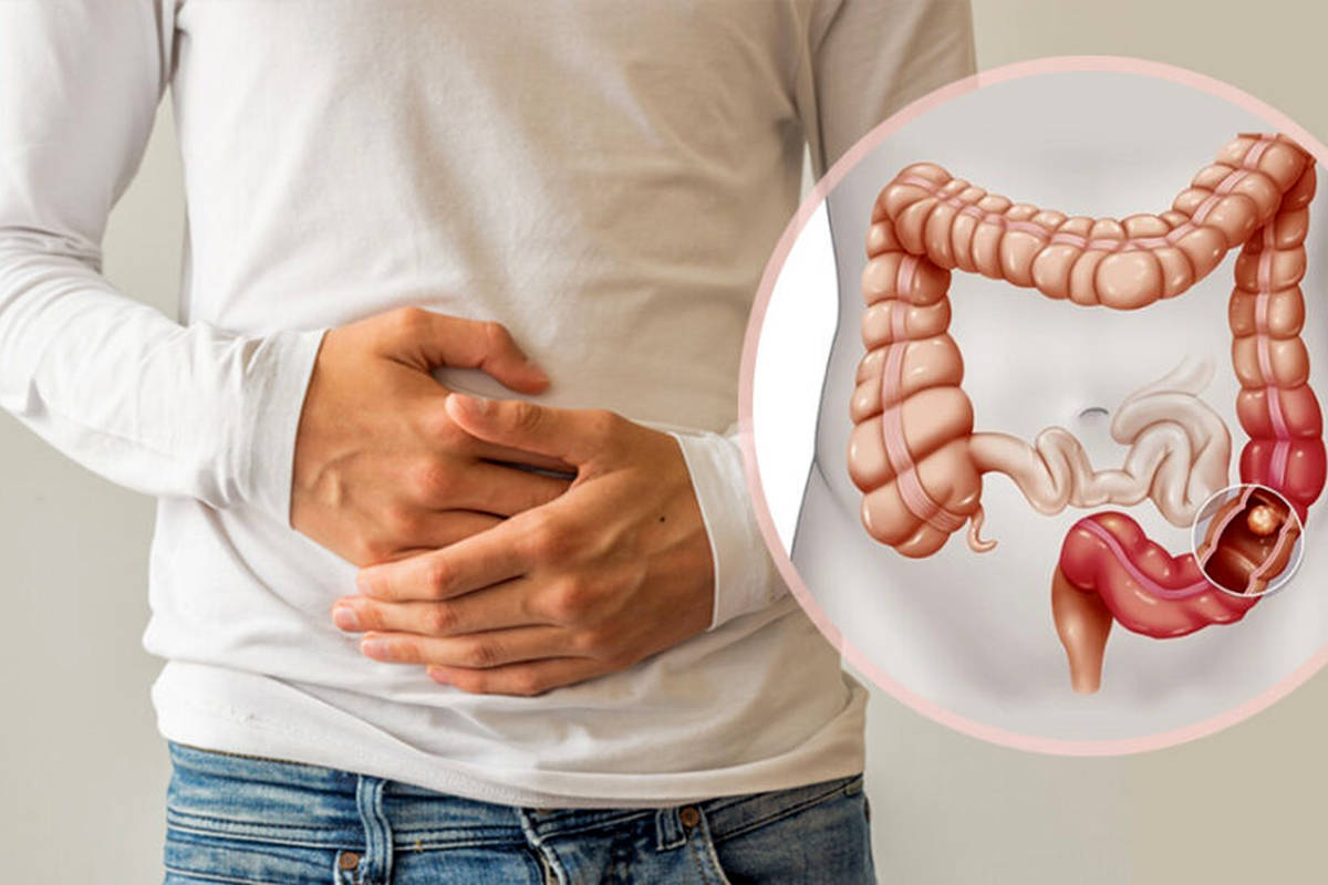 علائم اولیه و هشداردهنده سرطان روده بزرگ چیست؟ پیشگیری و راههای درمان