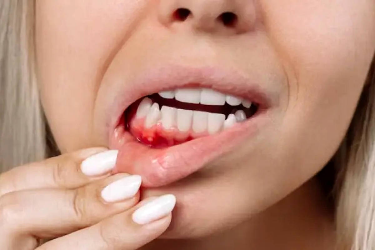 مصرف این نوشیدنیها سبب خونریزی لثه میشود