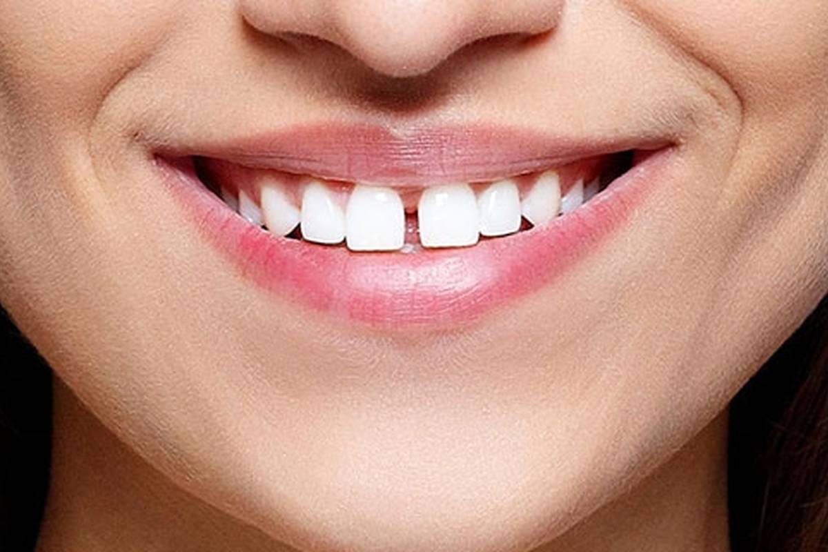 خوردن تخمه بین دندانها فاصله میاندازد؟