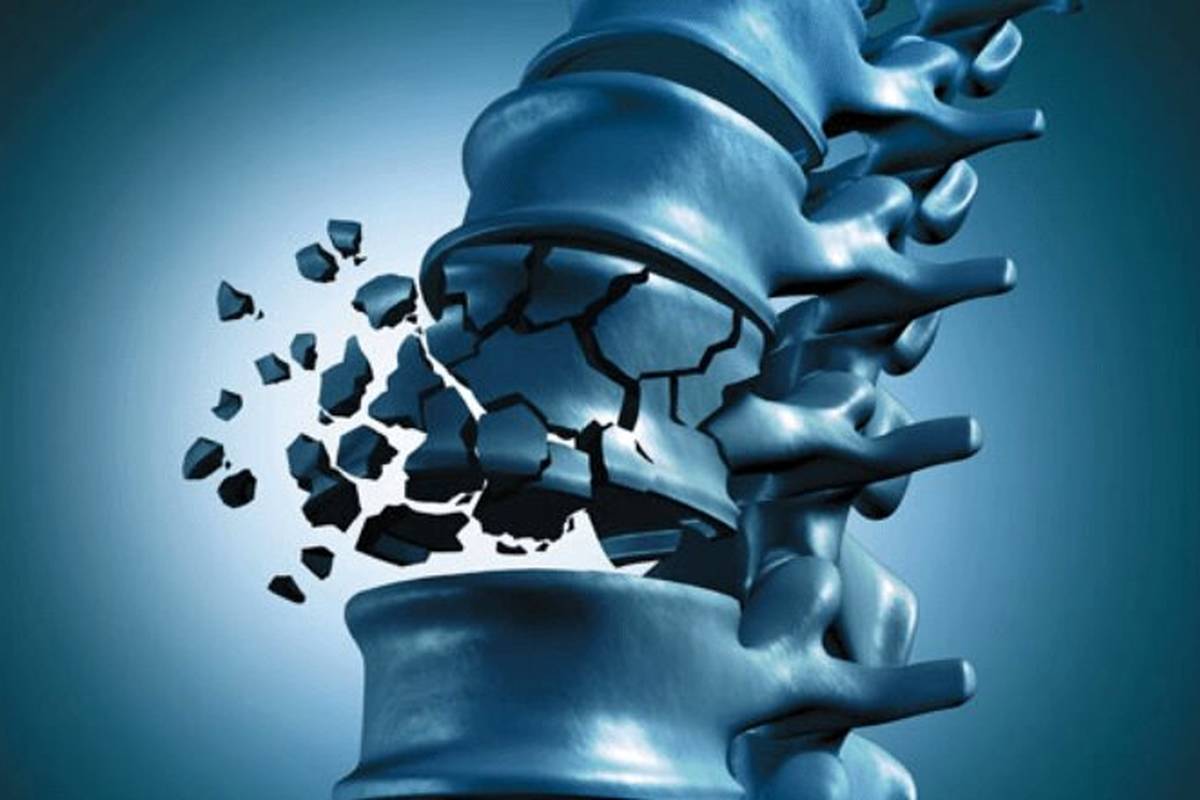 چگونه از شر پوکی استخوان راحت شویم؟