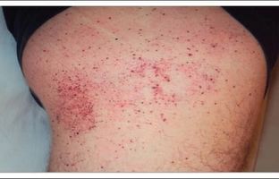 یک بیماری نادر که آقایان بیشتر به آن مبتلا می شوند