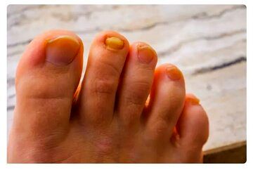 سندرم ناخن زرد چیست؟ علائم و درمان آن