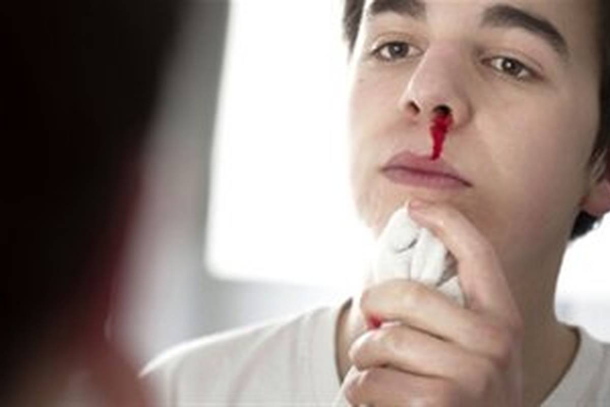 کمبود این ویتامینها باعث خون دماغ میشود