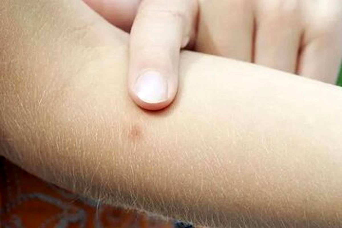 چرا جای نیش پشه میخارد؟
