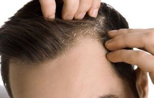 چرا شوره سر ایجاد می‌شود؟/ راه درمان