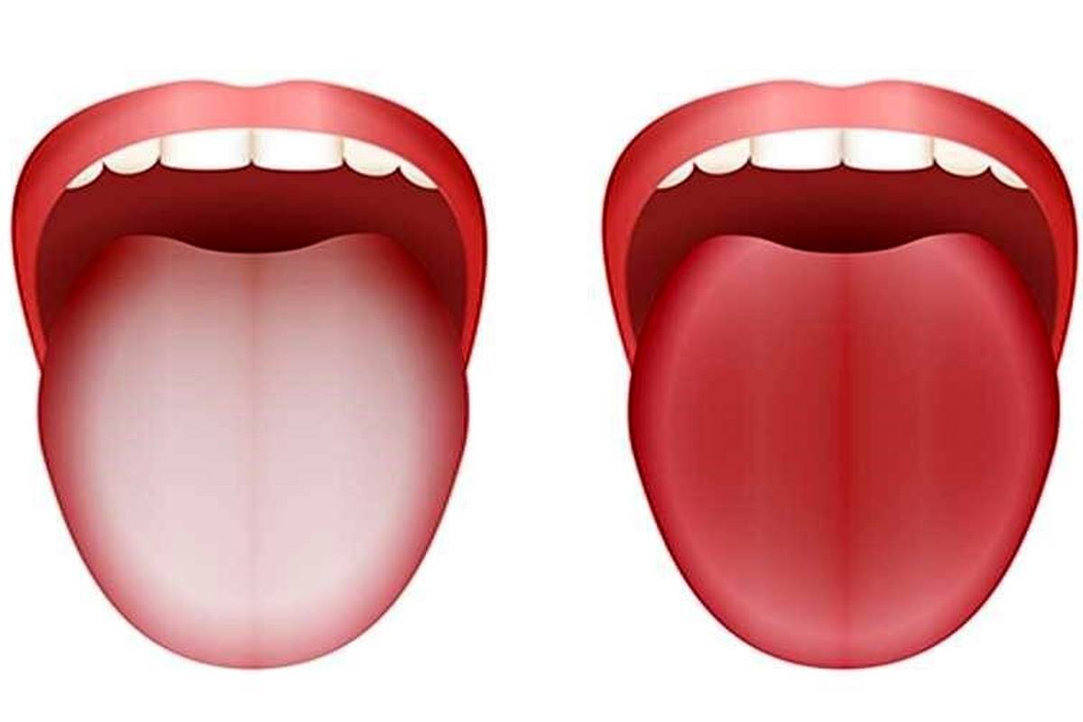 زبان سفید چه چیزی درباره سلامت میگوید؟