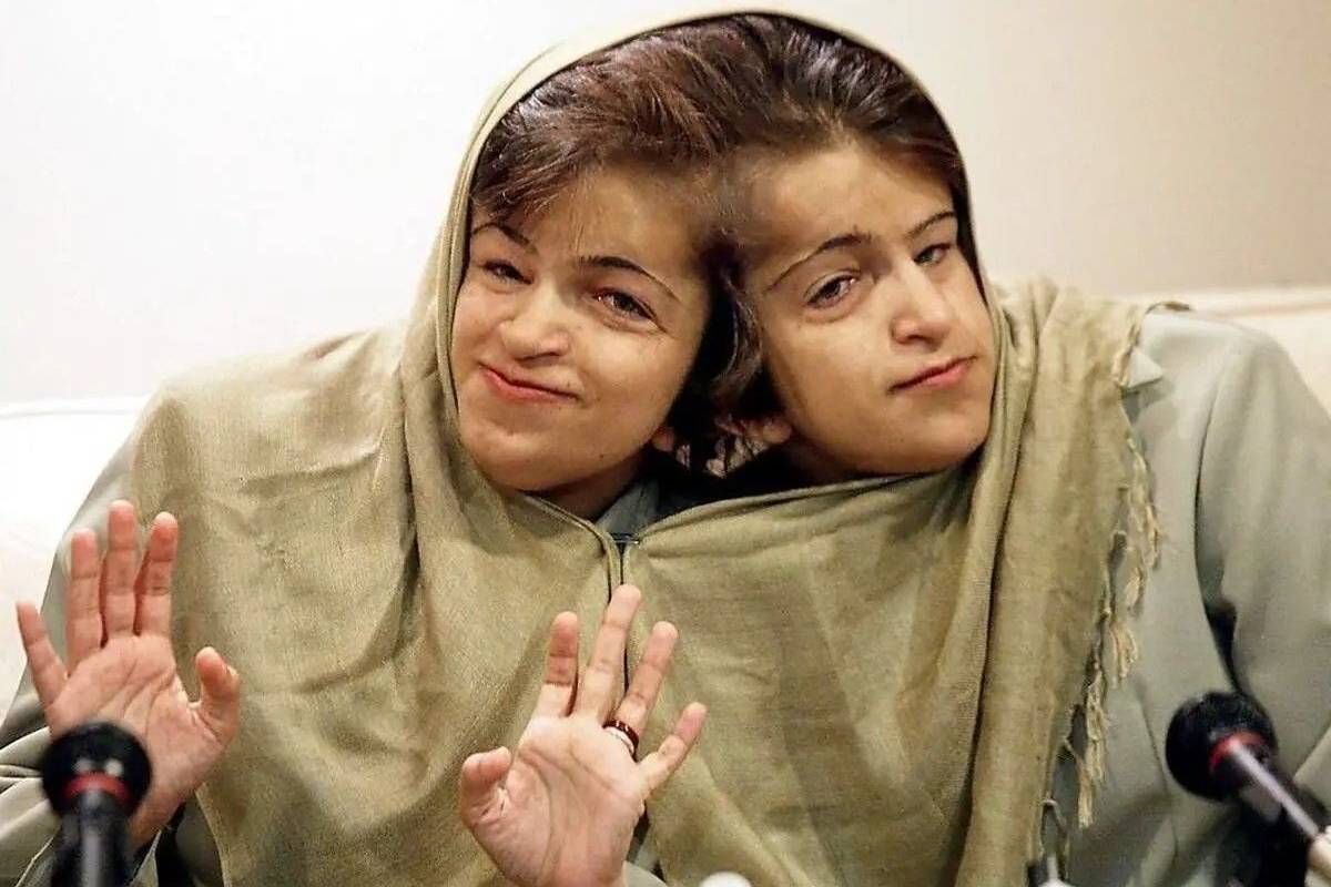قصه زندگی لاله و لادن; خواهرانی با دو مغز و یک قلب+ عکس مزار